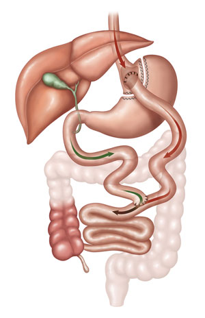 bypass-gastrico.jpg